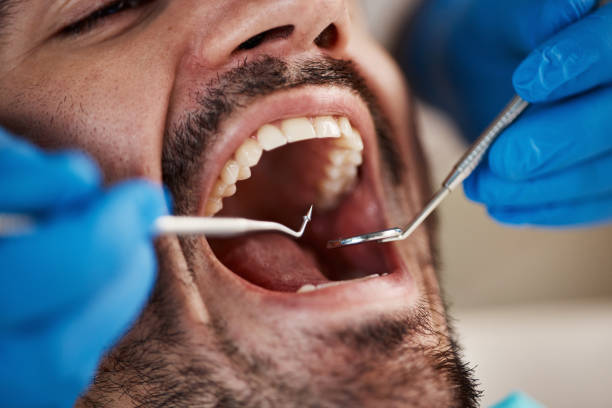 Best Emergency Dentist for Lost Fillings or Crowns in Boyd, TX